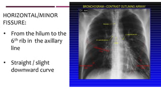• From the hilum to the
6th rib in the axillary
line
• Straight / slight
downward curve
HORIZONTAL/MINOR
FISSURE:
 