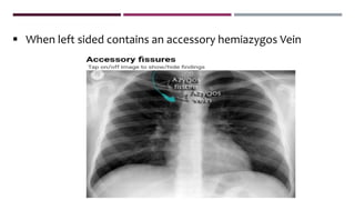  When left sided contains an accessory hemiazygos Vein
 