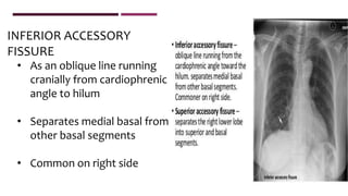 • As an oblique line running
cranially from cardiophrenic
angle to hilum
• Separates medial basal from
other basal segments
• Common on right side
INFERIOR ACCESSORY
FISSURE
 