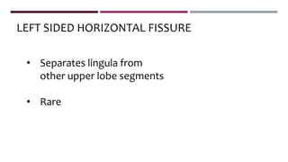 • Separates lingula from
other upper lobe segments
• Rare
LEFT SIDED HORIZONTAL FISSURE
 