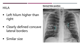 HILA
 Left hilum higher than
right
 Clearly defined concave
lateral borders
 Similar size
 