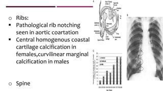 o Ribs:
 Pathological rib notching
seen in aortic coartation
 Central homogenous coastal
cartilage calcification in
females,curvilinear marginal
calcification in males
o Spine
 