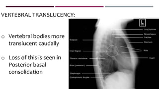 VERTEBRAL TRANSLUCENCY:
o Vertebral bodies more
translucent caudally
o Loss of this is seen in
Posterior basal
consolidation
 