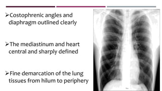 Costophrenic angles and
diaphragm outlined clearly
The mediastinum and heart
central and sharply defined
Fine demarcation of the lung
tissues from hilum to periphery
 