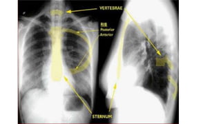 Normal chest x ray and collapse | PPTX