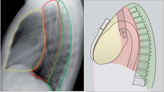 Normal chest x ray and collapse | PPTX