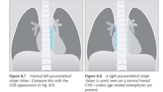 Normal chest x ray and collapse | PPTX
