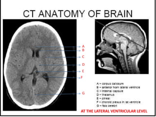 A
B
C
D
E
F
G
AT THE LATERAL VENTRICULAR LEVEL
 