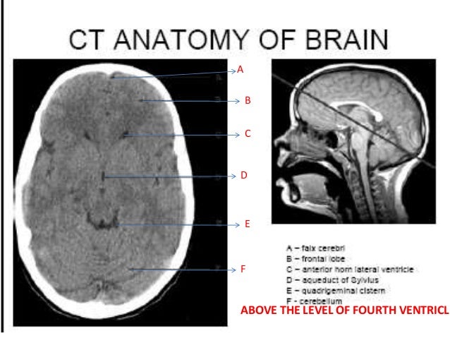 Normal CT BRAIN