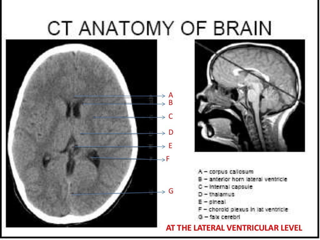 Normal CT BRAIN