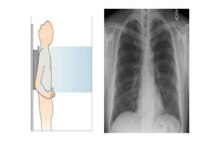 Normal cxr agp | PPT