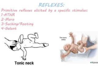 REFLEXES: 
Primitive reflexes elicited by a specific stimulus: 
1.ATNR 
2.Moro 
3.Sucking/Rooting 
4.Galant 
 
