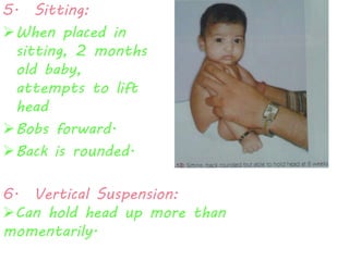 5. Sitting: 
When placed in 
sitting, 2 months 
old baby, 
attempts to lift 
head 
Bobs forward. 
Back is rounded. 
6. Vertical Suspension: 
Can hold head up more than 
momentarily. 
 