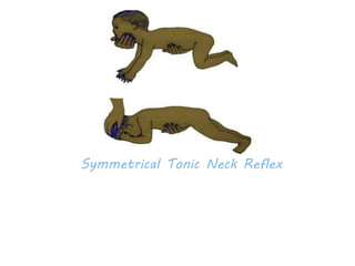 Symmetrical Tonic Neck Reflex 
 