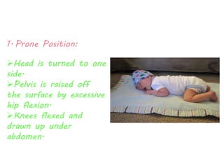 1. Prone Position: 
Head is turned to one 
side. 
Pelvis is raised off 
the surface by excessive 
hip flexion. 
Knees flexed and 
drawn up under 
abdomen. 
 