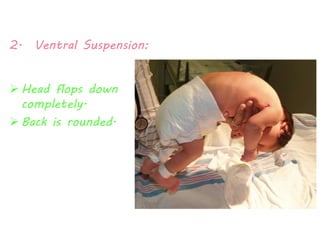 2. Ventral Suspension: 
 Head flops down 
completely. 
 Back is rounded. 
 
