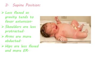 3. Supine Position: 
 Less flexed as 
gravity tends to 
favor extension. 
 Shoulders are less 
protracted. 
 Arms are more 
abducted. 
 Hips are less flexed 
and more ER. 
 