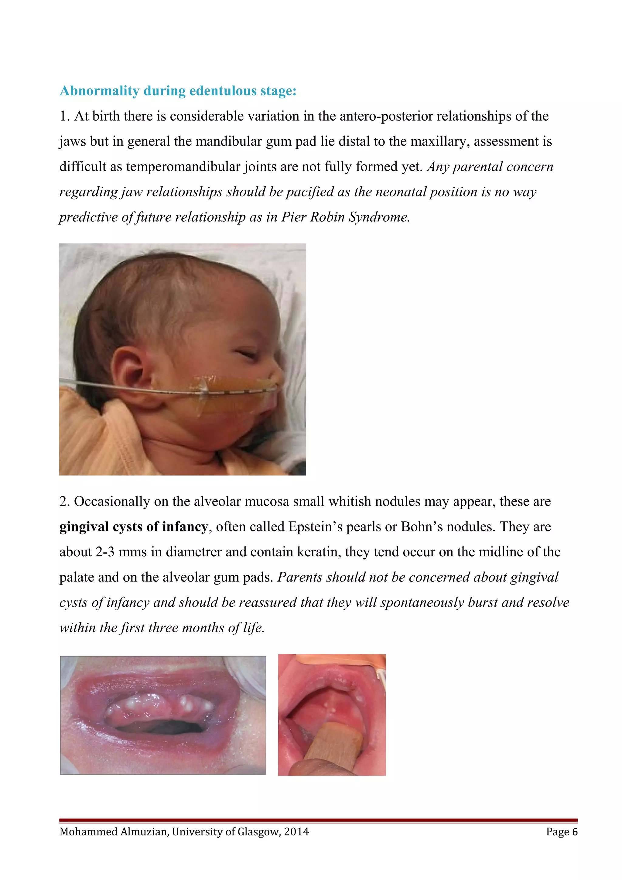 Abnormality during edentulous stage:
1. At birth there is considerable variation in the antero-posterior relationships of the
jaws but in general the mandibular gum pad lie distal to the maxillary, assessment is
difficult as temperomandibular joints are not fully formed yet. Any parental concern
regarding jaw relationships should be pacified as the neonatal position is no way
predictive of future relationship as in Pier Robin Syndrome.
2. Occasionally on the alveolar mucosa small whitish nodules may appear, these are
gingival cysts of infancy, often called Epstein’s pearls or Bohn’s nodules. They are
about 2-3 mms in diametrer and contain keratin, they tend occur on the midline of the
palate and on the alveolar gum pads. Parents should not be concerned about gingival
cysts of infancy and should be reassured that they will spontaneously burst and resolve
within the first three months of life.
Mohammed Almuzian, University of Glasgow, 2014 Page 6
 