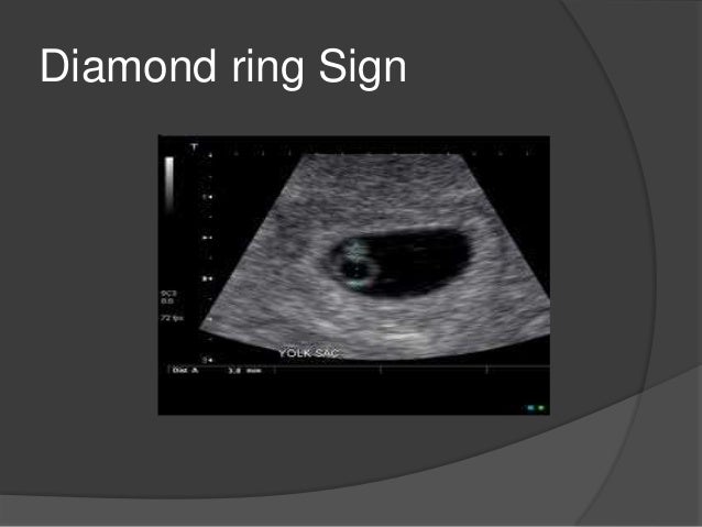 Most accurate time for dating ultrasound
