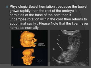  Physiologic Bowel herniation : because the bowel
grows rapidly than the rest of the embryo it
herniates at the base of the cord then it
undergoes rotation within the cord then returns to
abdominal cavity . Please Note that the liver never
herniates normally.
 
