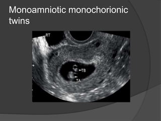 Monoamniotic monochorionic
twins
 