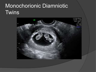 Monochorionic Diamniotic
Twins
 