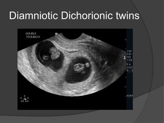 Diamniotic Dichorionic twins
 