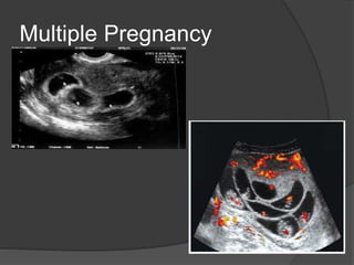 Multiple Pregnancy
 