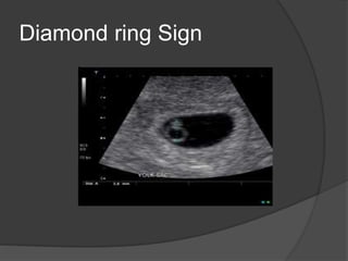 Diamond ring Sign
 