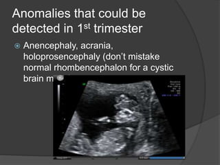 Anomalies that could be
detected in 1st trimester
 Anencephaly, acrania,
holoprosencephaly (don’t mistake
normal rhombencephalon for a cystic
brain mass)
 