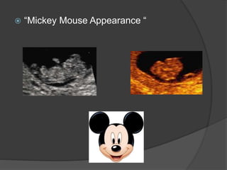  “Mickey Mouse Appearance “
 