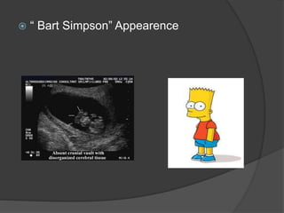  “ Bart Simpson” Appearence
 