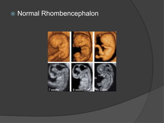  Normal Rhombencephalon
 