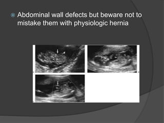  Abdominal wall defects but beware not to
mistake them with physiologic hernia
 