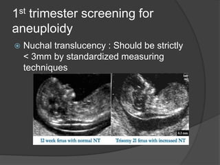 1st trimester screening for
aneuploidy
 Nuchal translucency : Should be strictly
< 3mm by standardized measuring
techniques
 