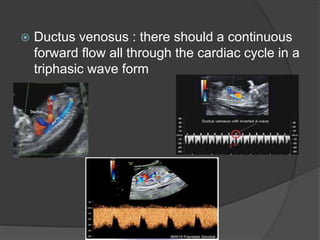  Ductus venosus : there should a continuous
forward flow all through the cardiac cycle in a
triphasic wave form
 