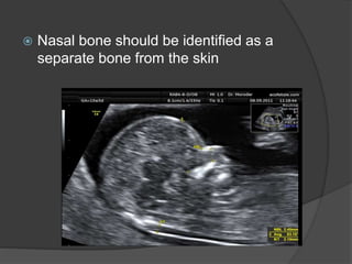  Nasal bone should be identified as a
separate bone from the skin
 