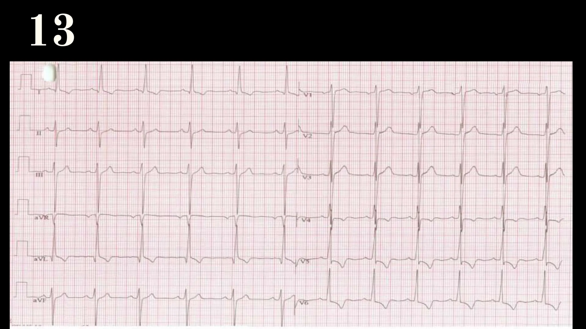NORMAL Electrocardiography for Medical and Nursing Students | PPTX