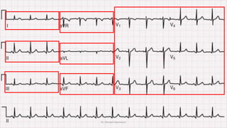 Normal and abnormal ECG pdf 123456789000 | PDF