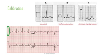 Normal and abnormal ECG pdf 123456789000 | PDF