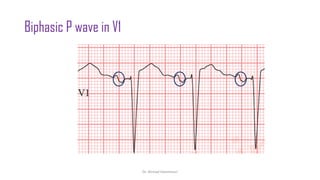 Normal and abnormal ECG pdf 123456789000 | PDF