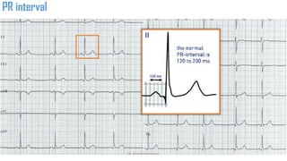 Normal and abnormal ECG pdf 123456789000 | PDF