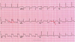 Normal and abnormal ECG pdf 123456789000 | PDF