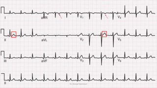 Normal and abnormal ECG pdf 123456789000 | PDF