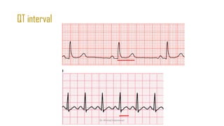 Normal and abnormal ECG pdf 123456789000 | PDF
