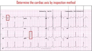 Normal and abnormal ECG pdf 123456789000 | PDF