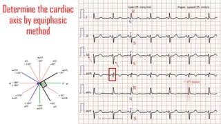 Normal and abnormal ECG pdf 123456789000 | PDF