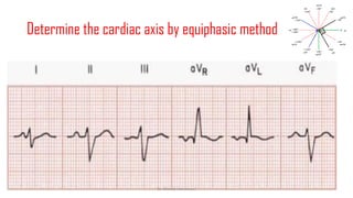 Normal and abnormal ECG pdf 123456789000 | PDF