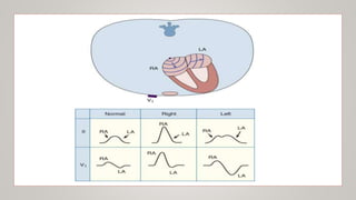 12 LEAD NORMAL ELECTROCARDIOGRAM | PPTX