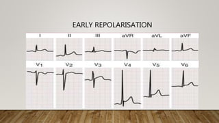 12 LEAD NORMAL ELECTROCARDIOGRAM | PPTX